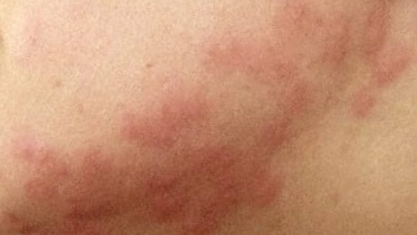 Bedbug bites and treatments