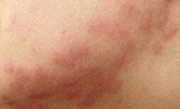 Bedbug bites and treatments