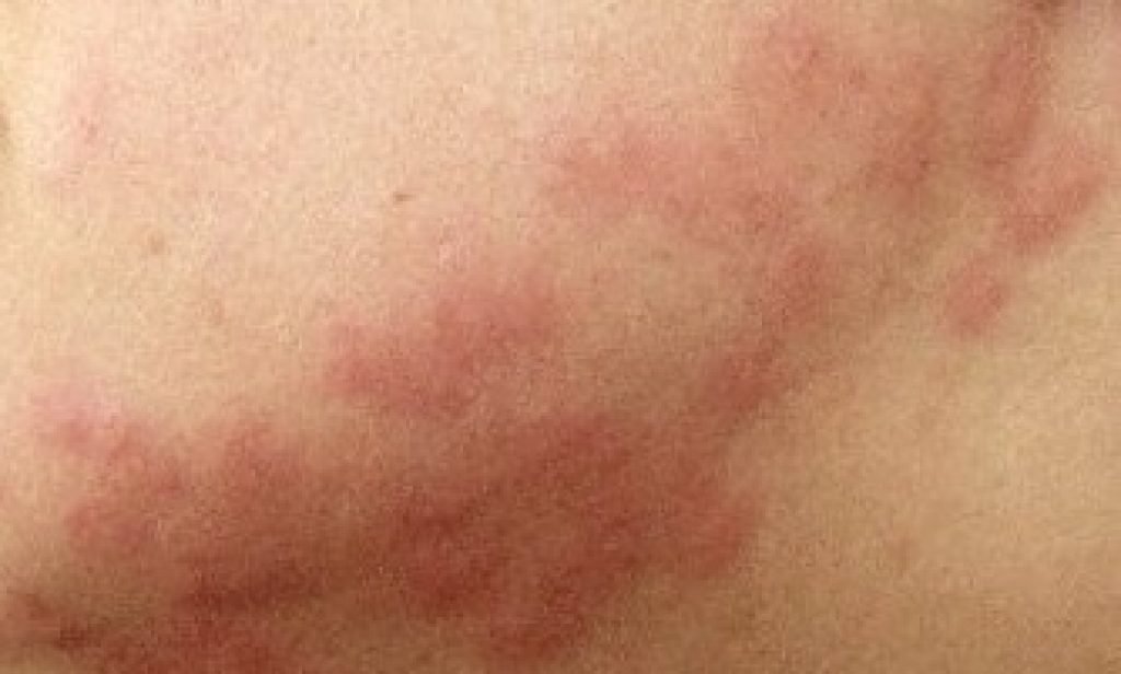 Bedbug bites and treatments